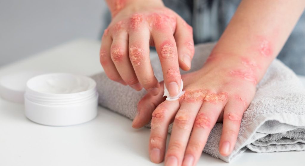 Applying CBD cream for psoriasis