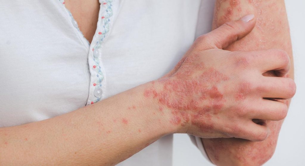 CBD oil for psoriasis UK - Skin psoriasis