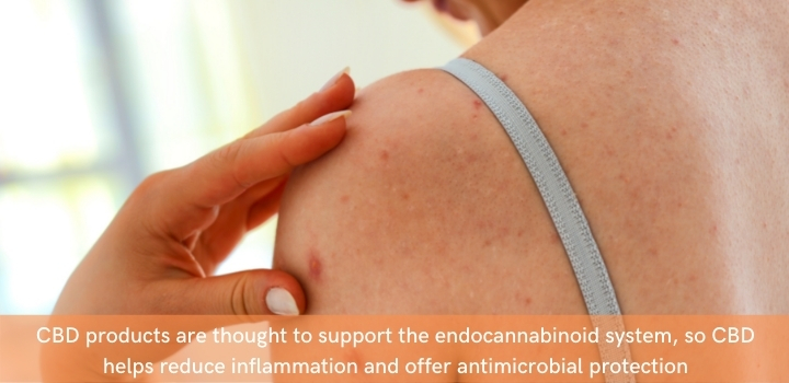 How does CBD help with eczema